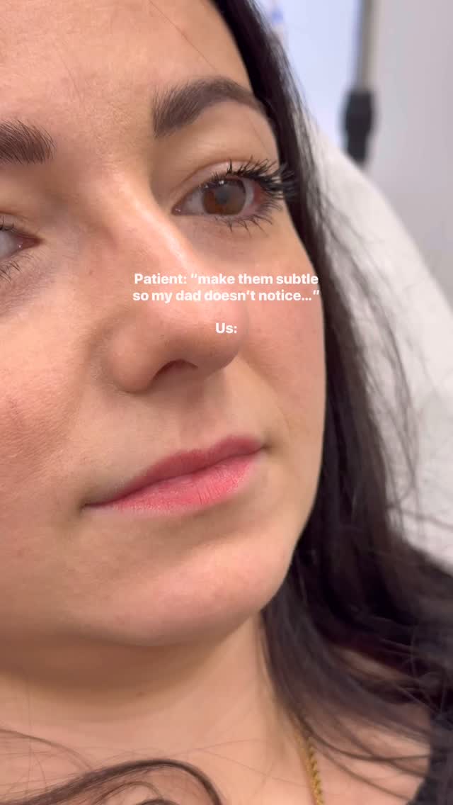 Subtle tweaks make the biggest difference. 👄✨
#LipFiller #DermalFillers #Consultation #Cockfosters #NorthLondon