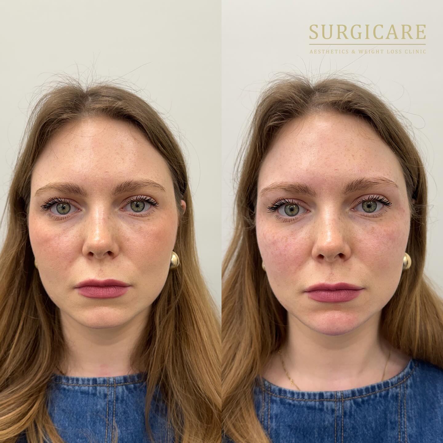 Before and immediately after 2ml of filler using the amazing dermal fillers from @restylane ✨
A huge thank you to our lovely patient for choosing Surgicare and travelling all the way from the Netherlands to see us đź’™
Can you guess which areas we’ve treated? 👀
#SurgicareResults #FacialRejuvenation #PostWeightLossJourney #TearTroughFiller #CheekFiller #ChinFiller #ConfidenceRestored